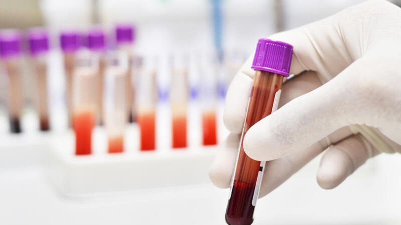 تعرف على أهم 3 نصائح حول تحليل ترسيب الدم