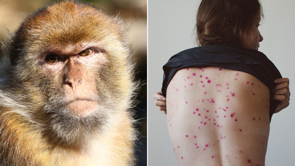 بالفيديو.. أبرز أعراض مرض جدري القرود وكيفية انتقاله إلى الأشخاص