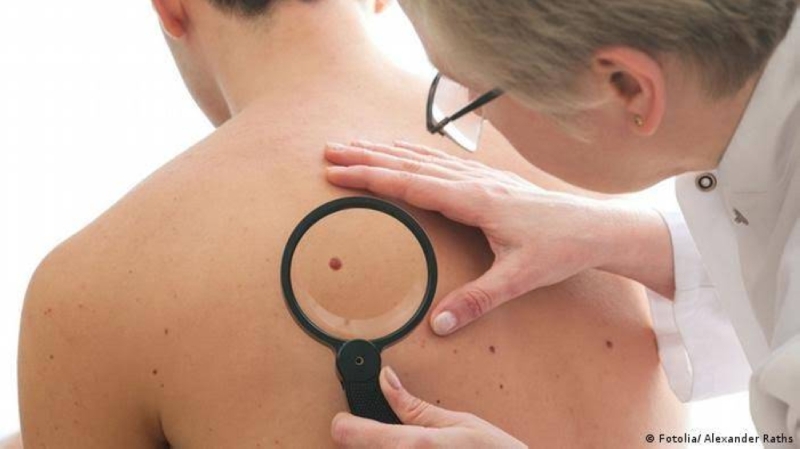  علامات تحول الشامات إلى سرطان الجلد