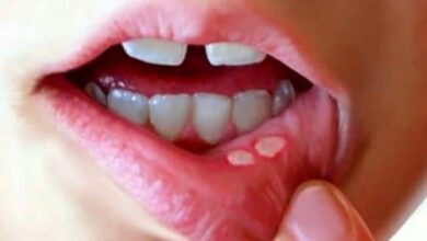 ع��اج فطريات الفم عند الاطفال وطرق الوقاية منها