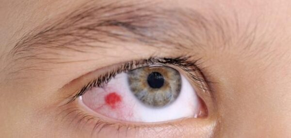 علامات سرطان العين الأكثر شيوعا وطرق العلاج