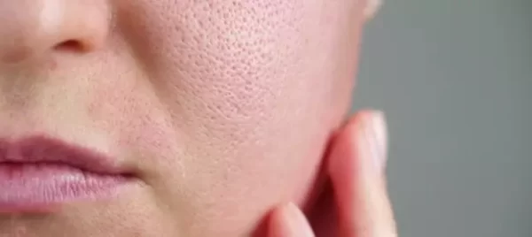 علاج المسامات الواسعة في الوجه والأنف وتحت الإبط