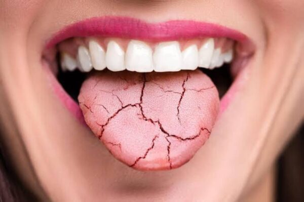 ماذا يعني جفاف الفم وماهي الأمراض الخطيرة التي يوحي إليها ؟